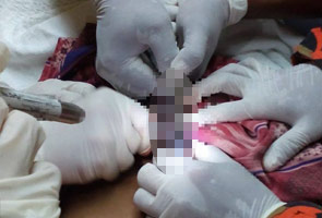 Firemen help take out ring from penis