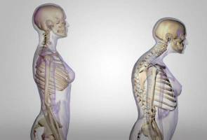 Wanita, kanak-kanak berisiko tinggi hidap osteoporosis Wanita, kanak-kanak berisiko tinggi hidap osteoporosis