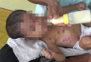 Kanak-kanak dua tahun derita badan, muka dipenuhi lepuhan air Kanak-kanak dua tahun derita badan, muka dipenuhi lepuhan air
