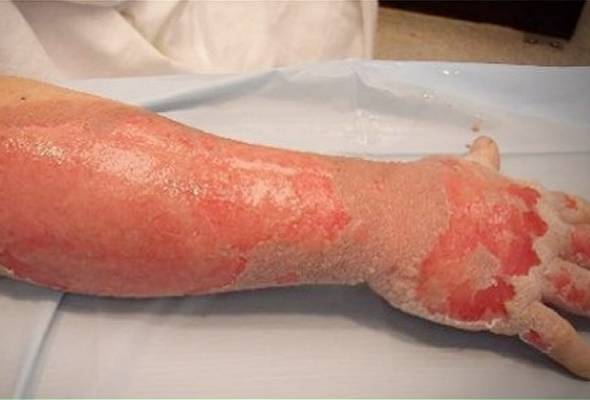 Lelaki melecur teruk dipercayai dibakar di dalam tandas pusat beli-belah Lelaki melecur teruk dipercayai dibakar di dalam tandas pusat beli-belah