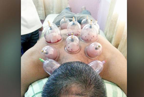 Badan lesu? Jangan risau, berbekam kini dibenarkan Badan lesu? Jangan risau, berbekam kini dibenarkan