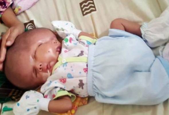 Bayi berwajah dua di Batam Bayi berwajah dua di Batam