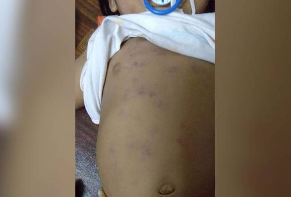 Tidak berhenti menangis, bayi 10 bulan dicubit pengasuh hingga lebam Tidak berhenti menangis, bayi 10 bulan dicubit pengasuh hingga lebam