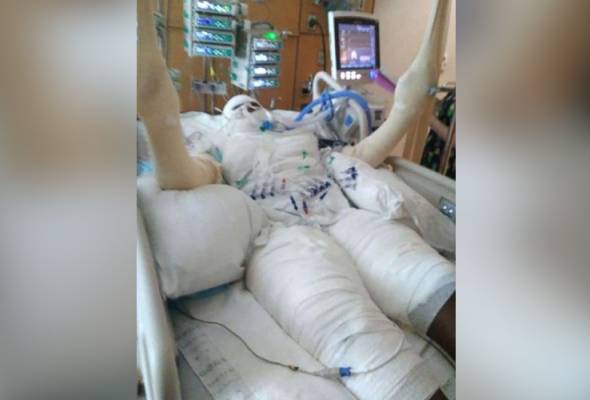 Bakar diri semata-mata untuk dapat 'likes' di media sosial Bakar diri semata-mata untuk dapat 'likes' di media sosial