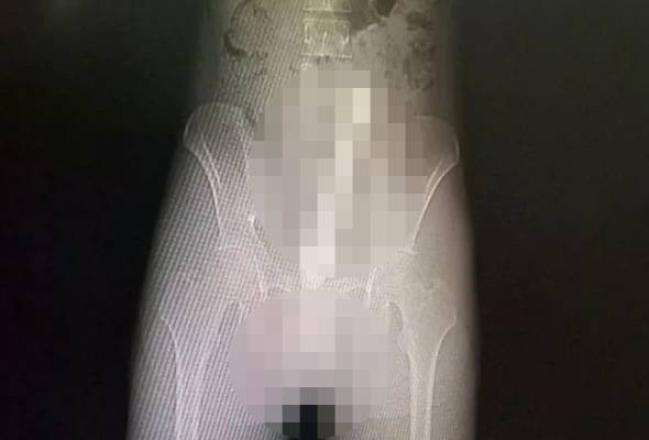 Gara-gara melampiaskan nafsu, alat perangsang tersangkut di dubur Gara-gara melampiaskan nafsu, alat perangsang tersangkut di dubur