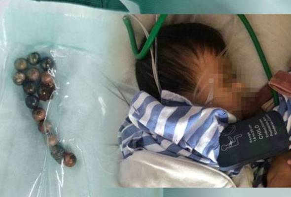 Perut dan usus bayi koyak akibat tertelan 14 manik magnet Perut dan usus bayi koyak akibat tertelan 14 manik magnet