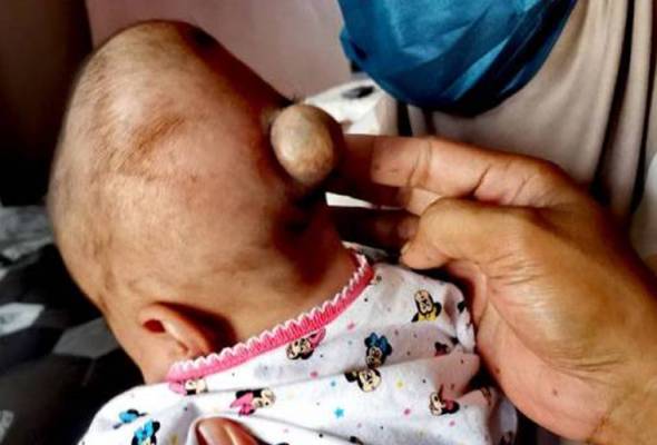 Bayi 3 Bulan Derita Otak Terkeluar Astro Awani