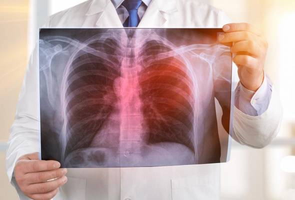 KKM: Kes Tibi meningkat, 2,571 kes direkodkan minggu kelima 2026